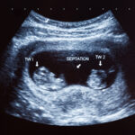 ultrasound of twins