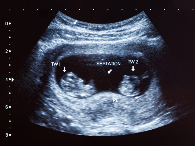 ultrasound of twins